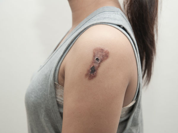 சரும புற்றுநோய் அபாயம் குறையும்