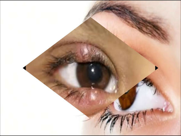 இரண்டாம் நிலை கண் புற்று நோய்