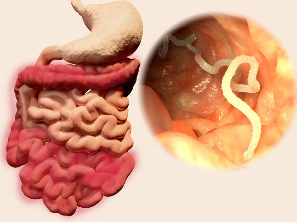 Effective Granny Ways To Remove Stomach Worms Effective Granny Ways To Remove Stomach Worms