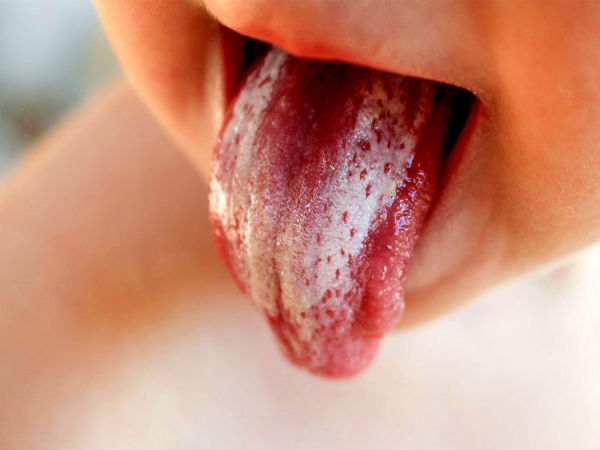 வெண்படலங்கள்