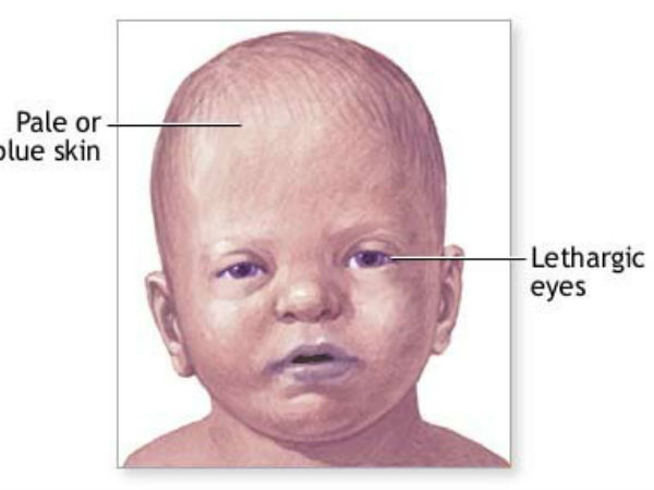 அறிகுறிகள்