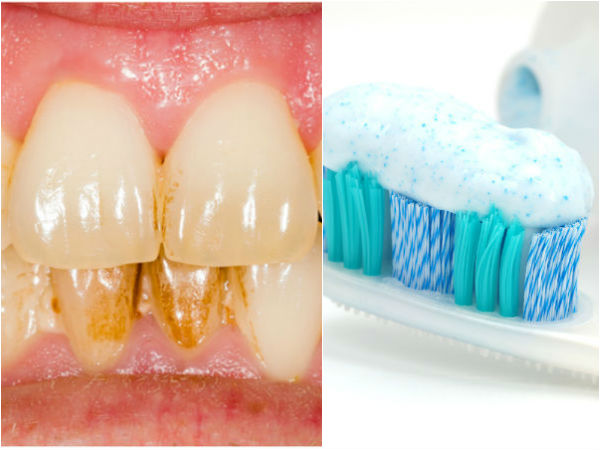 டார்ட்டர் (கறைகள்) எதிர்ப்பு பற்பசை: