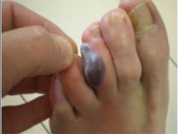 ரத்தக்கட்டு