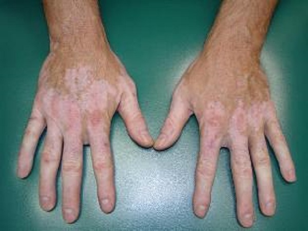 போட்டோதெரபி