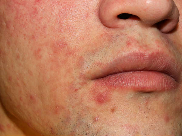 முகப்பரு குறைக்க உதவுகிறது