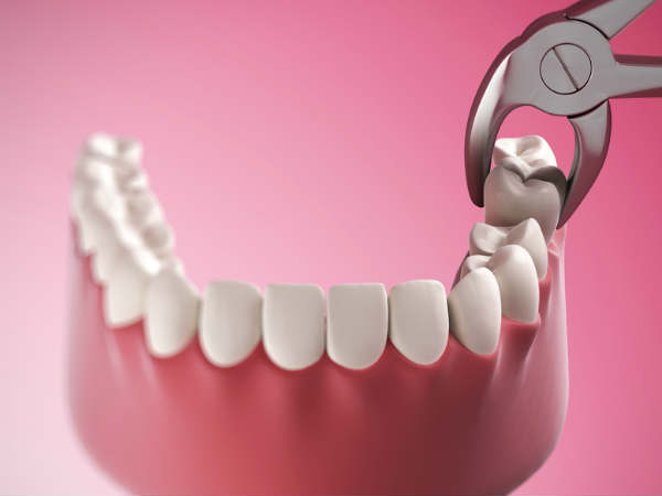 பற்களை பிடுங்குதல்