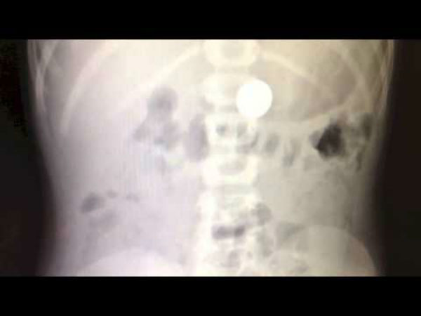 குடலில் மாட்டிக்கொண்டால்