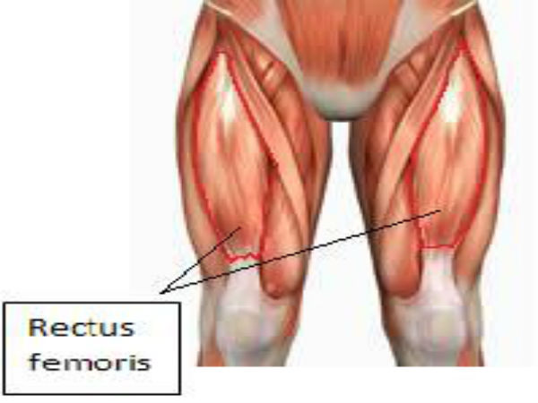 ரக்டஸ் ஃபெமோரிஸ்