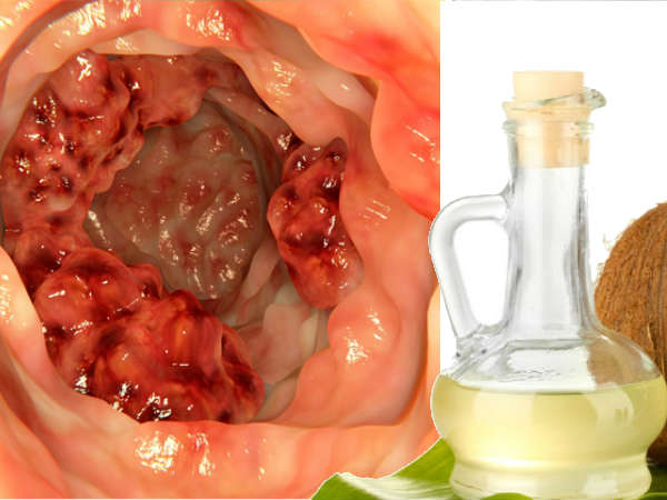 புற்றுநோய் செல்கள் புற்றுநோய் செல்கள்