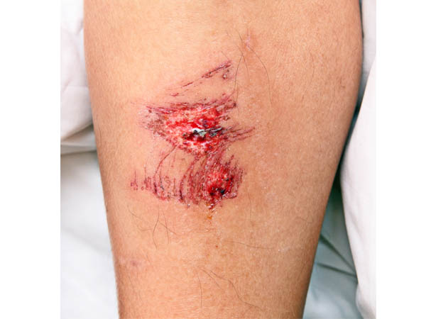 கடிபட்ட இடத்தை வெட்டாதீர்கள்