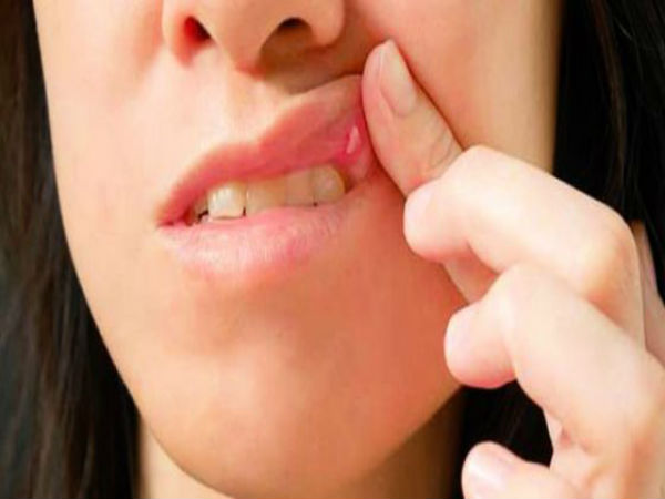 வாய் வெண் புண்கள்