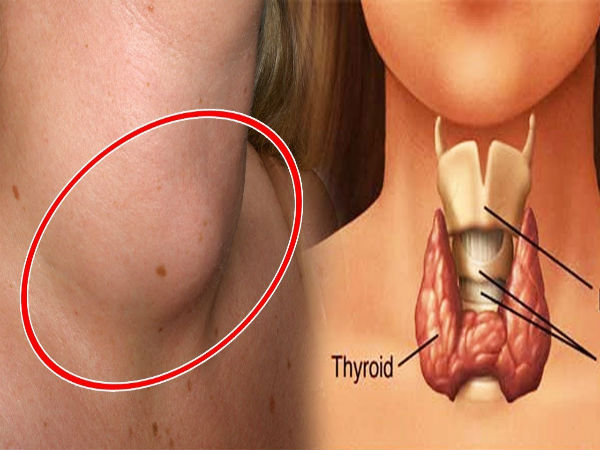 ஹைப்பர் தைராய்டிசம் மற்றும் கருவுறுதல்