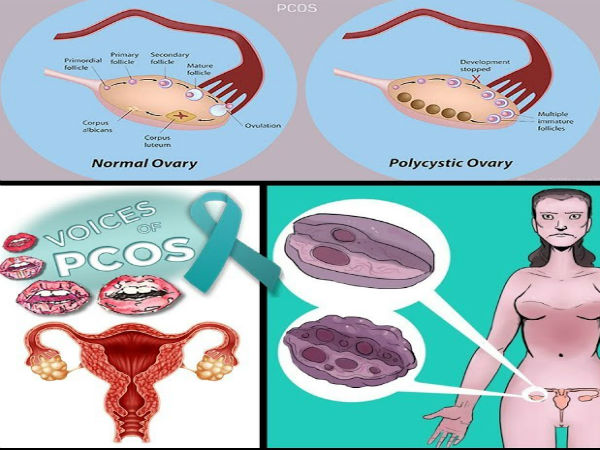 பாலிசிஸ்டிக் கருப்பை நோய்