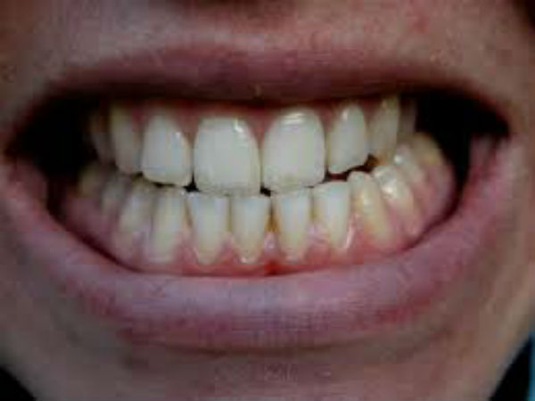 பல்லீறு 