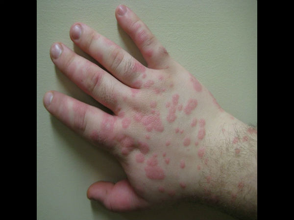 Urticaria என்றால் என்ன?