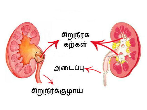 ஏன் கற்கள் உருவாகிறது..?
