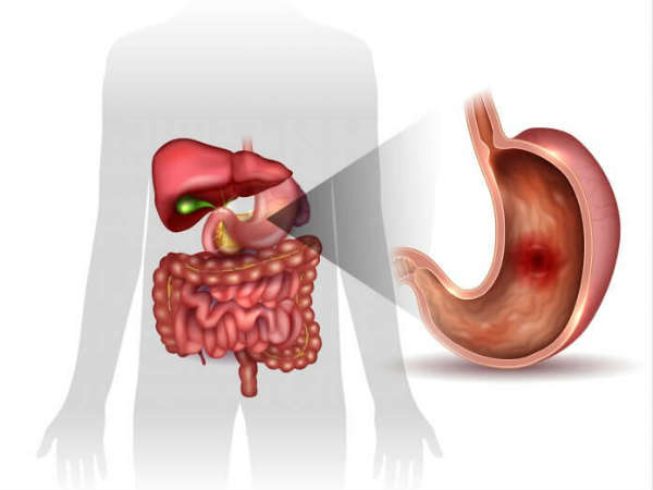 வயிறு மற்றும் குடல் புண்கள்