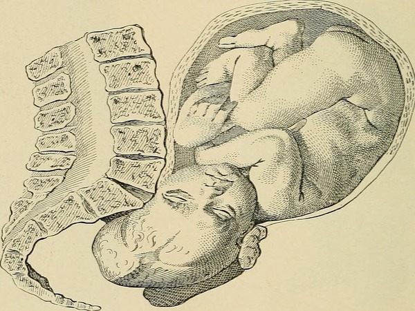 பிறப்புறுப்பு கிழிதல்!