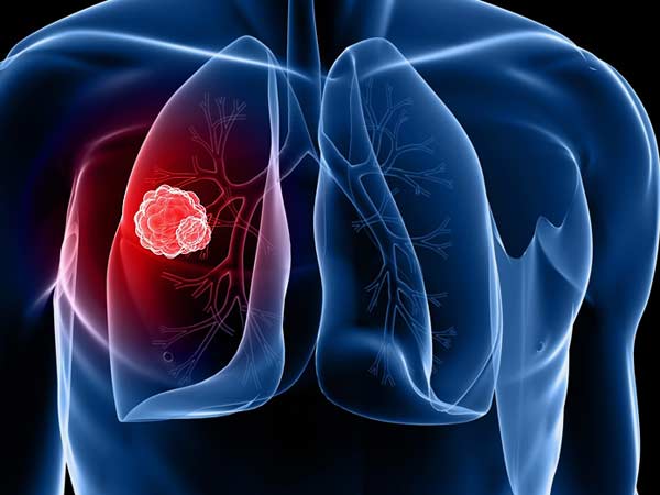 புற்றுநோய்!