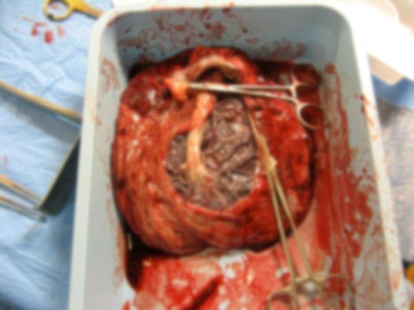 நஞ்சுக்கொடி முந்து பிரசவம் 