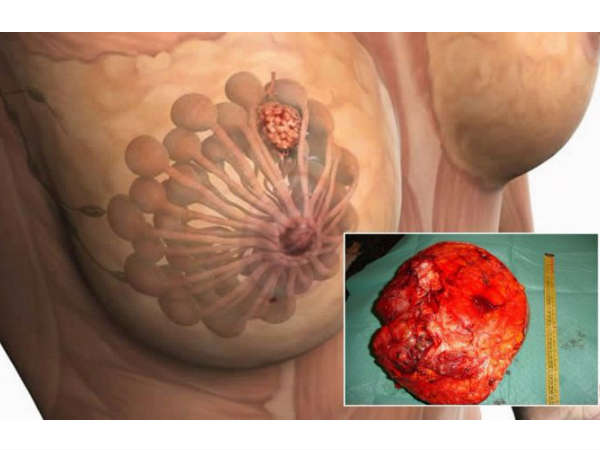 What Causes Breast Cancer? What Causes Breast Cancer?