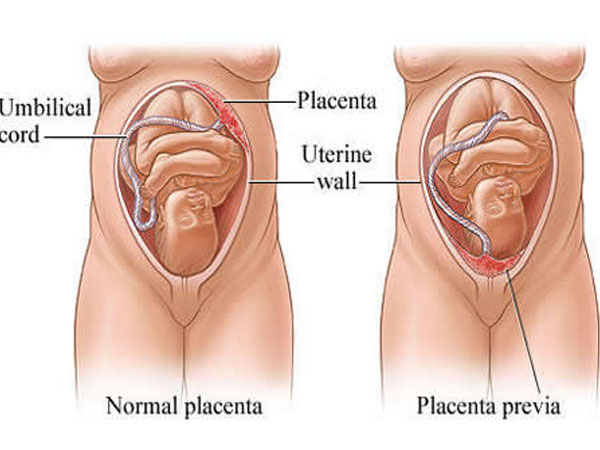 Placenta Previa: All You Need To Know