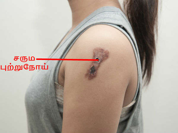 மச்சத்தில் முடி