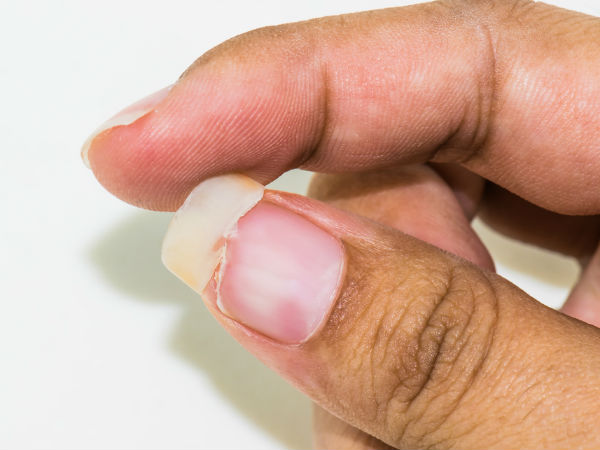 நகம் உடைதல் 