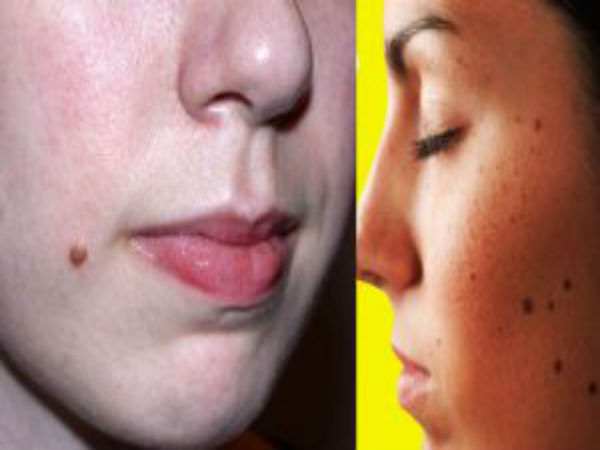 வித்தியாசமான மச்சம்