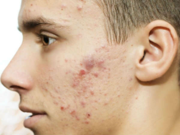 பிம்பிள் பஸ்டர்