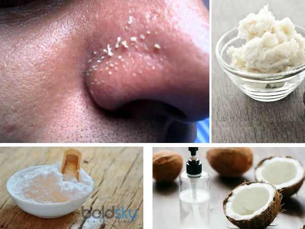 பேக்கிங் சோடா மற்றும் தேங்காய் எண்ணெய் 