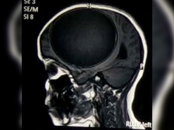 வலிப்பு உண்டாக வாய்ப்பு