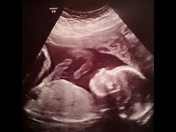 பிறப்புக் குறைபாடு