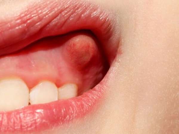 பற்கள் பாதிப்பு