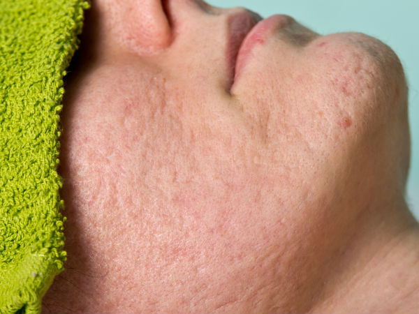 சரும துளைகளை மூடுகிறது