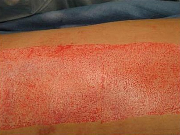 ஆரோக்கியமான தோலை எடுத்தல்