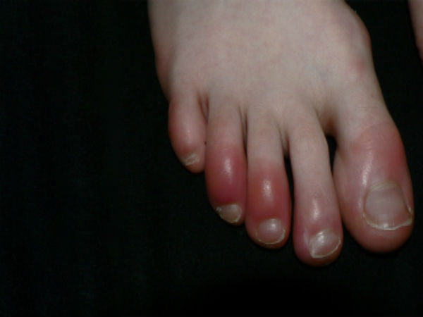 நாட்பட்ட கம்பார்ட்மென்ட் சிண்ட்ரோம் 