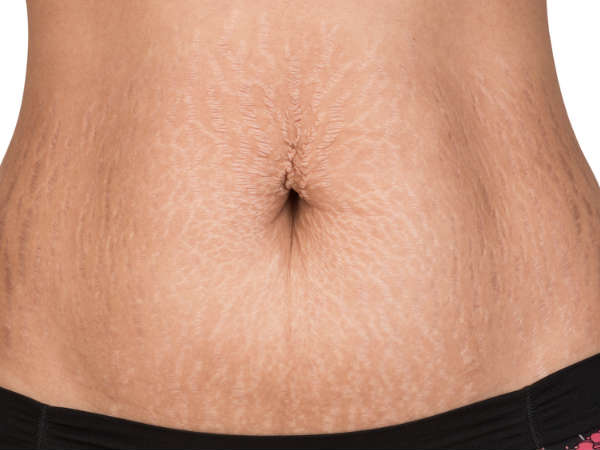 சரும வெடிப்பு 