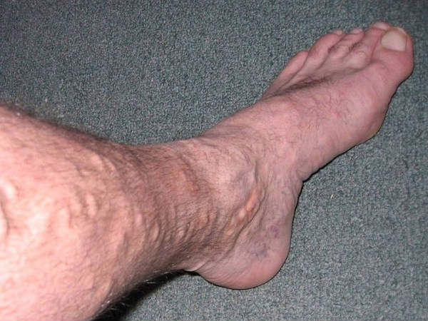 அறிகுறிகள்