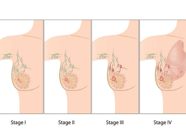 விட்டமின் டி பற்றாக்குறை
