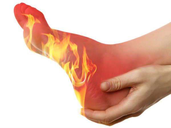 தீக்காயம்