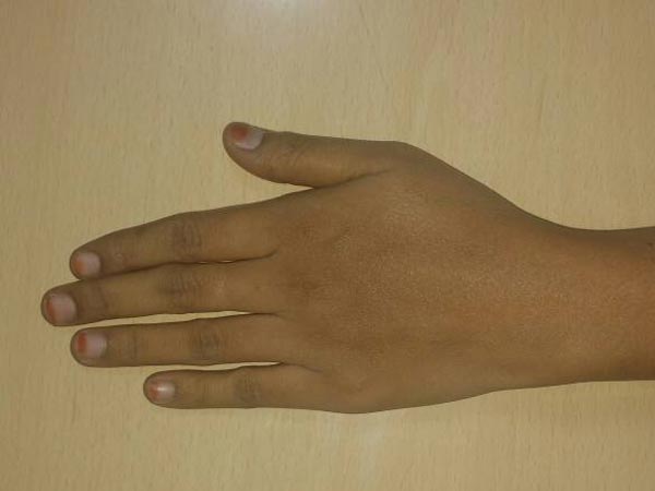 நகங்களின் நிறம் மாறுவது