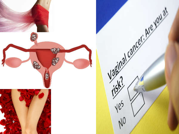 யோனி வகை புற்றுநோய் 