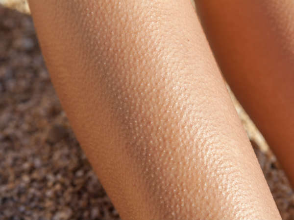 Goosebumps: What Are They And Why You Get Them Goosebumps: What Are They And Why You Get Them