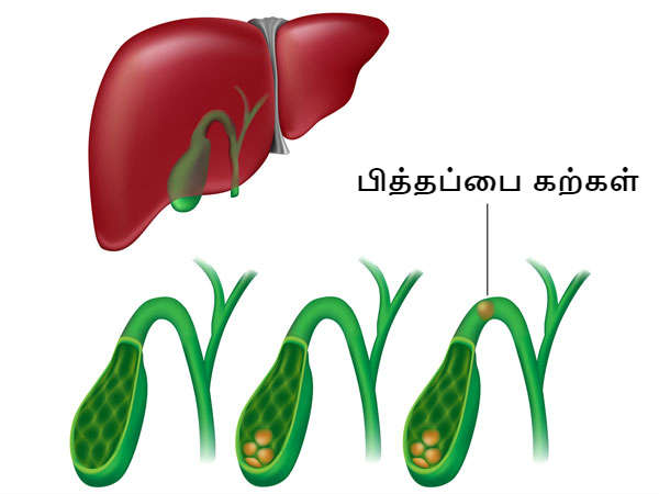 பித்த நீர்க்கட்டி 
