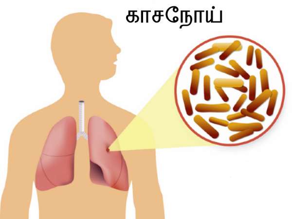 காசநோய்