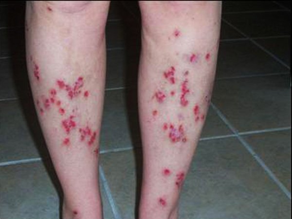 மோர்கெலோன்ஸ்