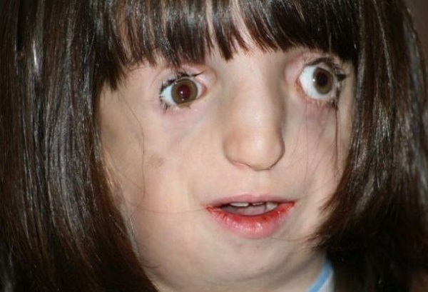 மோபியஸ் சிண்ட்ரோம்