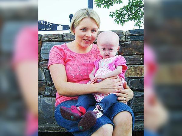 புரோஜீரியா