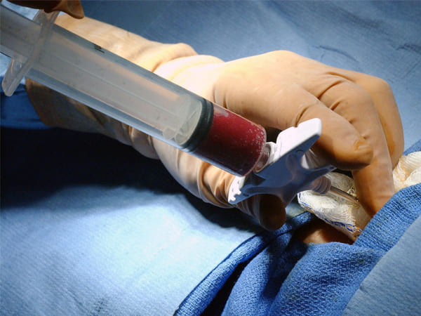 கடுமையான மைலாய்டு லுகேமியாவின் சிகிச்சைகள்